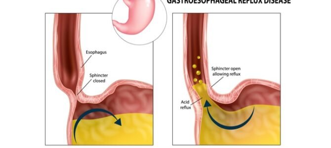 GERD: Understanding and Managing Acid Reflux